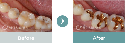 인레이 치료사례 전후사진