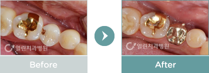 크라운 치료사례 전후사진