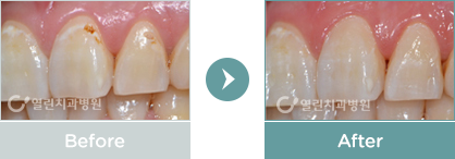 레진 치료사례 전후사진